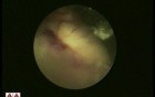 Endoscopy