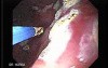 Watermelon Stomach (6 of 7) - Treatment with Argon Plasma Coagulator (APC)