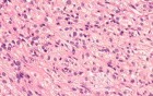 Gastrointestinal Stromal tumor (GIST) (60 of 65)