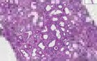 Rapidly progressive glomerulonephritis