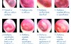 Acute Inflammation of Middle Ear