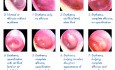 Acute Inflammation of Middle Ear