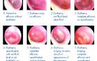 Acute Inflammation of Middle Ear