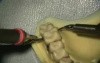 Ultrasonic Endoscopic  Debridement Simulation (UL Palatal, Facial)