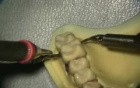 Ultrasonic Endoscopic  Debridement Simulation (UL Palatal, Facial)