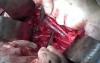 Radical Surgery with Anatomy Lecture - Pelvic Vessels and Structures