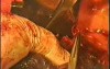 Bilobectomy