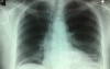 Gastrointestinal Perforation