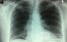 Gastrointestinal Perforation