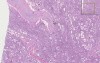 Arteries - Arterio- And Arteriolo-Sclerosis