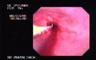 Reflux Esophagitis & Esophageal Stricture - Baloon Dilation
