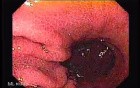 Esophageal Varices - Endoscopy (5 of 5)