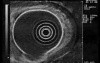 Scirrhous Gastric Carcinoma - Endoscopic Ultrasonography (10 0f 15)