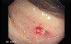 Polyp Inside Of Sigmoid Diverticulum (1 of 2)