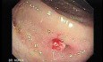 Polyp Inside Of Sigmoid Diverticulum (1 of 2)