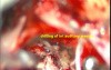 Acoustic Schwannoma -micro surgical excision- Preservation of Facial Nerve