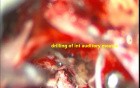 Acoustic Schwannoma - Preservation of Facial Nerve