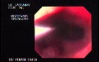 Reflux Esophagitis & Esophageal Stricture - Baloon Dilation Outcome