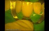 Ceramic Veneers Adhesive Cementation (4/4)