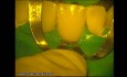 Ceramic Veneers Adhesive Cementation (4/4)