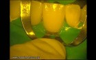Ceramic Veneers Adhesive Cementation (4/4)
