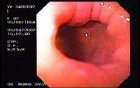 Crohn's Disease - Endoscopy (28 of 28)