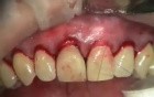 Old Crown Margin Makeover