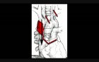 Superior Venea Cava Resection Without Blood Flow Interruption