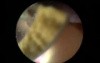 Stones In The Urinary Bladder