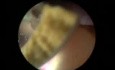 Stones In The Urinary Bladder