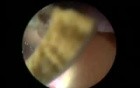Stones In The Urinary Bladder