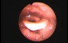 Fishbone Impaction at Lingual Tonsil