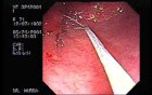 Adenomatous Gastric Polyp - Endoscopy Polypectomy