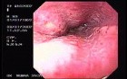 Hemorrhagic Esophagitis Due To Alcoholism - Mucosal Ulceration