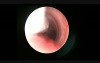 Unilateral Total Arytenoidectomy In Children