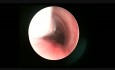 Unilateral Total Arytenoidectomy In Children