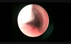 Unilateral Total Arytenoidectomy In Children