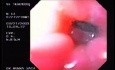 Banding of esophageal varices (7 of 17)