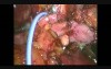 Advanced Hepatic Robotic Surgery