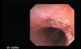Traqueostomy Fistula (3 of 5)