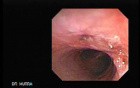 Traqueostomy Fistula (3 of 5)
