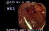 Big Polyp - Polypectomy