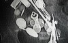 Multiple Foreign bodies in the GI tract (5 of 12)