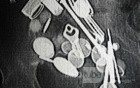 Multiple Foreign bodies in the GI tract (5 of 12)