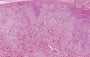 Adrenal - Nodular Hyperplasia