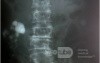 Nephrolithiasis Dextra