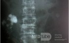 Nephrolithiasis Dextra