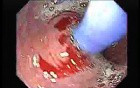 Achalasia - residual food (6 of 11)