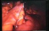 Jejunal Gastrointestinal Stromal tumor (GIST) (30 of 86)