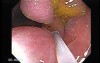 Colonoscopic Polypectomy (6 of 18)